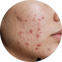A close-up image of skin affected by acne showing red pimples and blemishes on the cheek.