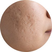 A close-up view of irregular skin texture showing imperfections and scars.