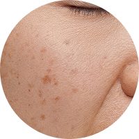 A close-up view of skin with pigmentation irregularities and blemishes.