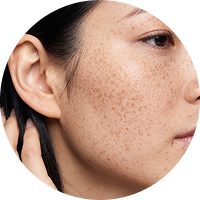 A close-up side view of a person's face showing freckles on the skin.