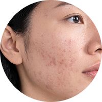A close-up side profile of a person showing skin with post-inflammatory hyperpigmentation, featuring reddish-brown spots.