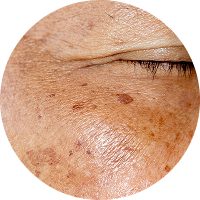 Close-up view of skin affected by melasma, showing dark patches and uneven skin tone.
