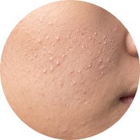 A close-up view of skin texture showing small bumps and imperfections.