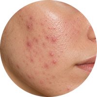 A close-up view of a person's cheek displaying acne-prone skin with several visible pimples.