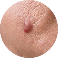 A close-up view of a skin lesion on human skin, highlighting its texture and color.