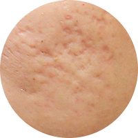 A close-up view of skin with acne texture, showing red bumps and blemishes.
