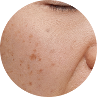 Close-up view of skin showing pigmentation and dark spots on the cheek.