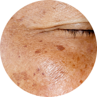 Close-up view of skin showing melasma patches and pigmentation.