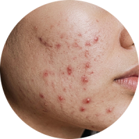Close-up of a person's cheek displaying acne and active breakouts.