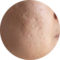 Close-up view of a person's skin showing acne scarring and marks.