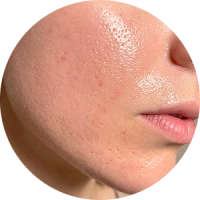 A close-up view of skin showing enlarged pores and oily texture.
