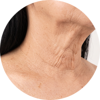 A close-up view of the neck skin showing signs of early ageing and laxity.