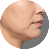A close-up profile view of a person's chin and jawline, highlighting volume and contour issues.