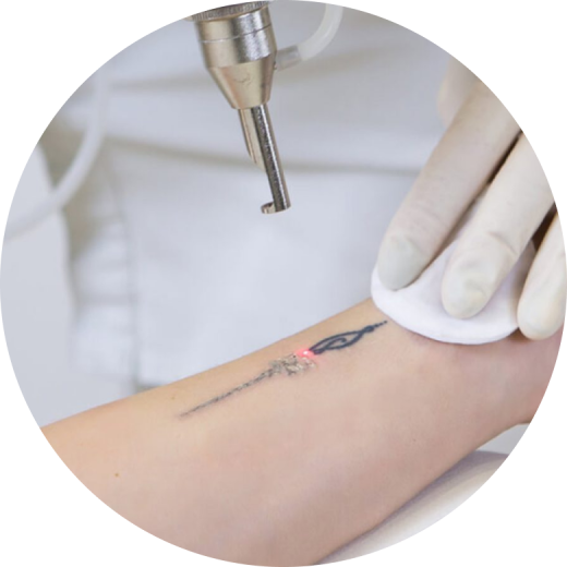 A close-up of a hand undergoing tattoo removal with a pico laser, showing the laser light on the skin and a cotton pad being used.