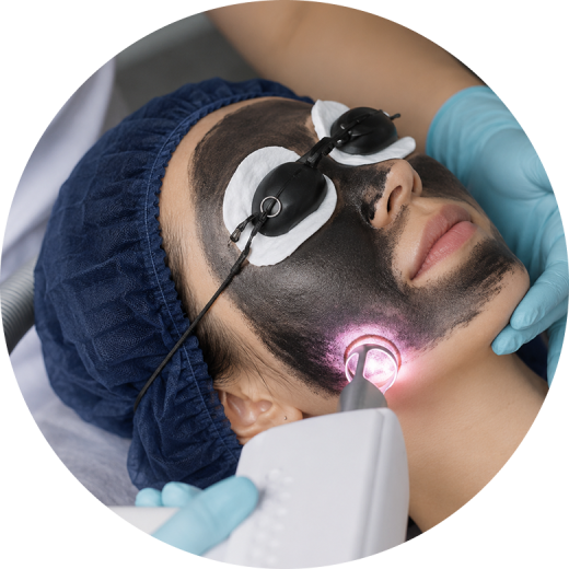 A woman undergoing a carbon peel facial treatment with a laser device, wearing protective goggles.