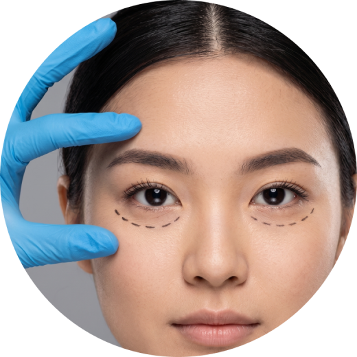 A close-up of a woman's face with markings under her eyes, indicating the area for under-eye fillers, as a gloved hand gently pulls the skin.