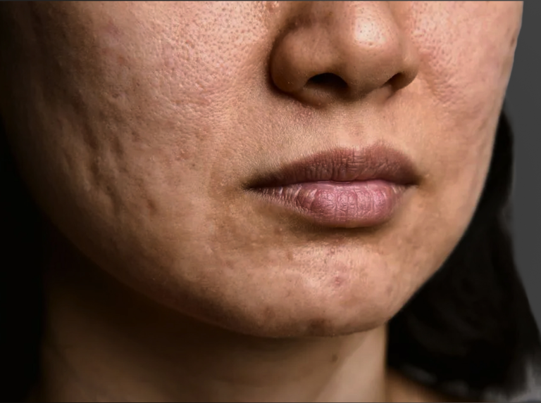 A close-up view of a person's chin and lips, showcasing uneven skin texture and visible pores.