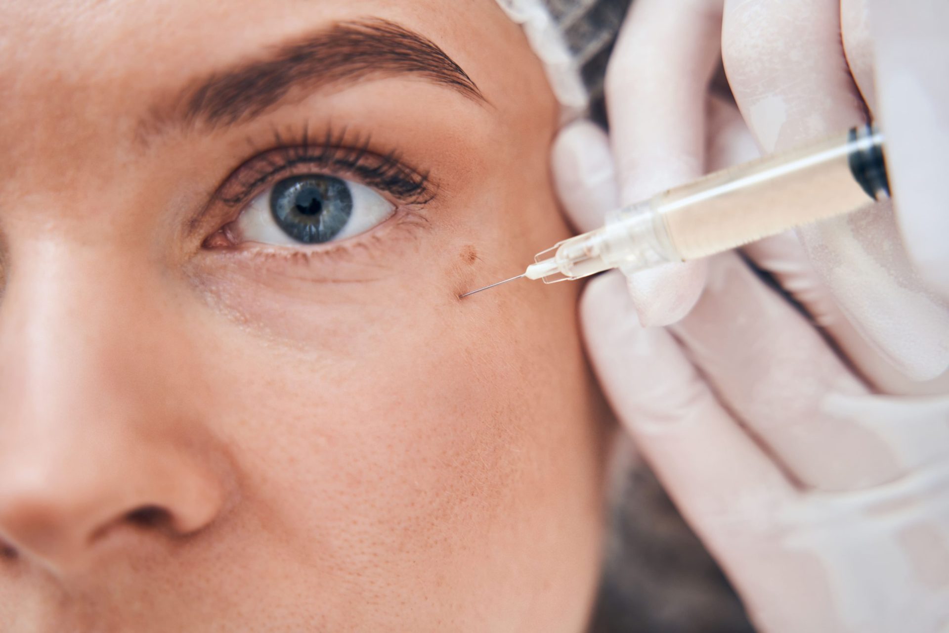 A close-up of a woman's eye during a beauty procedure, where a needle is being applied to the skin near her eye.