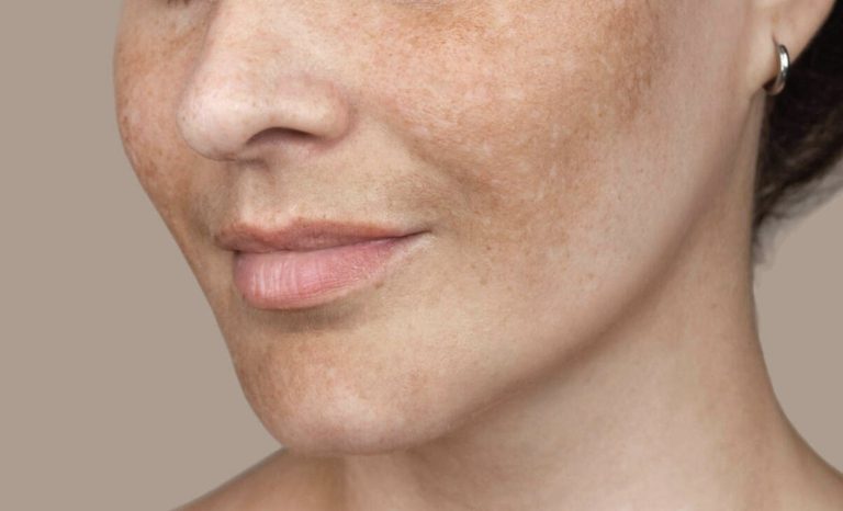 A close-up of a woman's facial skin showing a natural complexion with freckles.