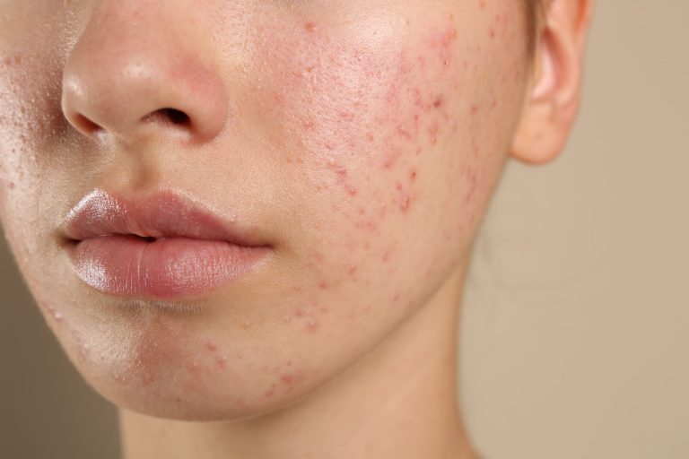 A close-up image of a woman's face showing a skin condition, highlighting areas of acne and blemishes.