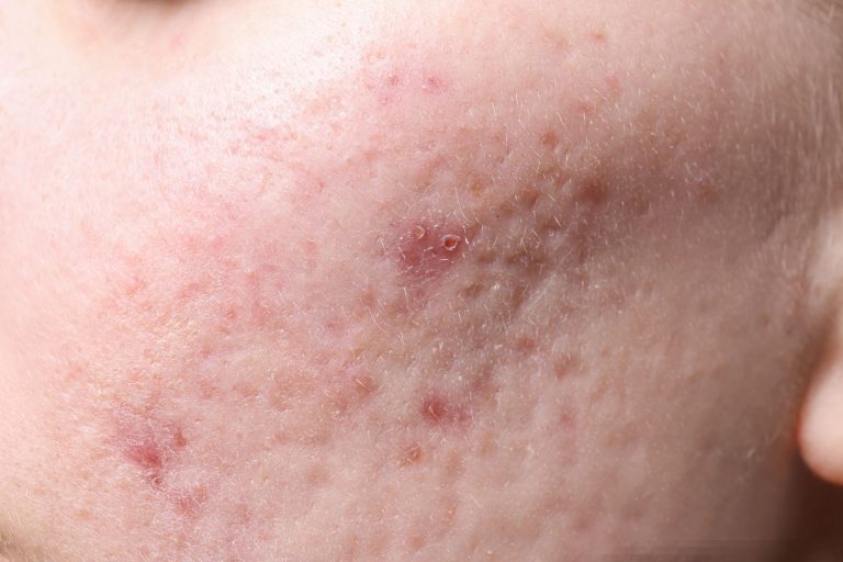 A close-up view of a skin condition showing acne and blemishes on the face.