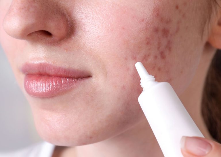 A close-up view of a person applying acne treatment to their cheek, highlighting areas of acne.