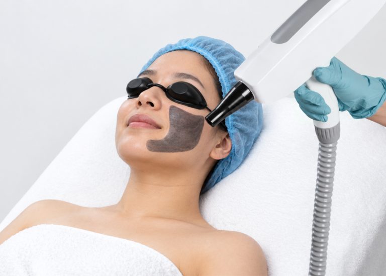 A woman undergoing a carbon laser treatment with protective goggles and a laser device in a clinical setting.