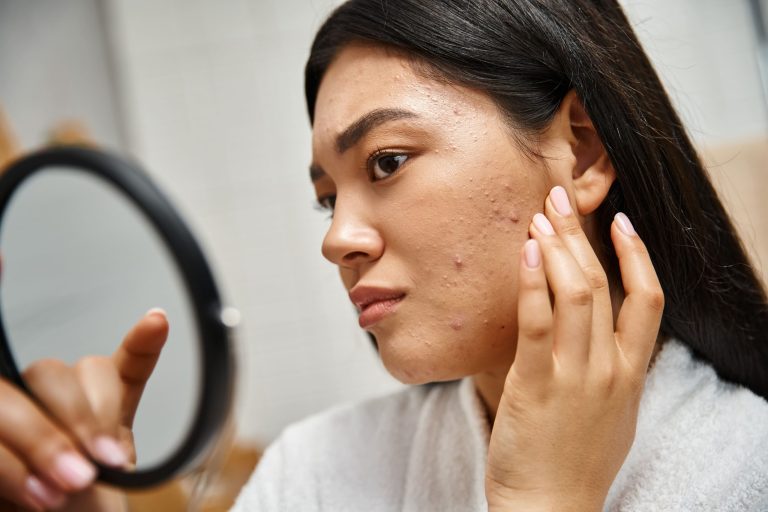 A young woman closely examining her skin in a mirror, with visible blemishes.