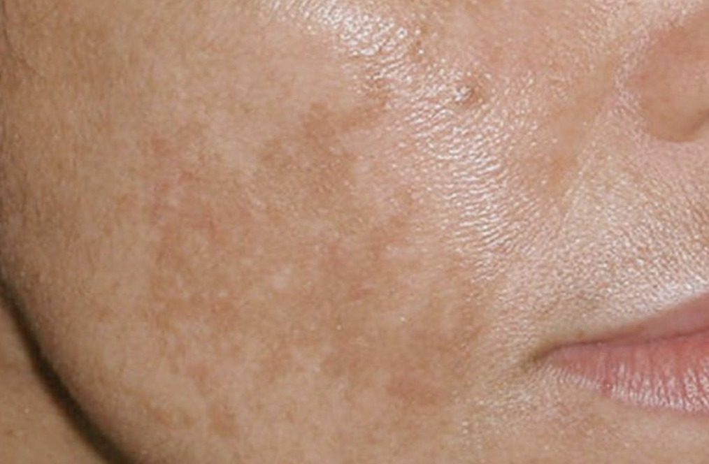 A close-up view of a person's cheek showing skin texture and discoloration.