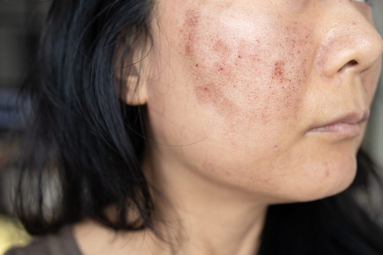 A close-up view of a woman's face showing post-treatment skin with visible redness and healing marks.