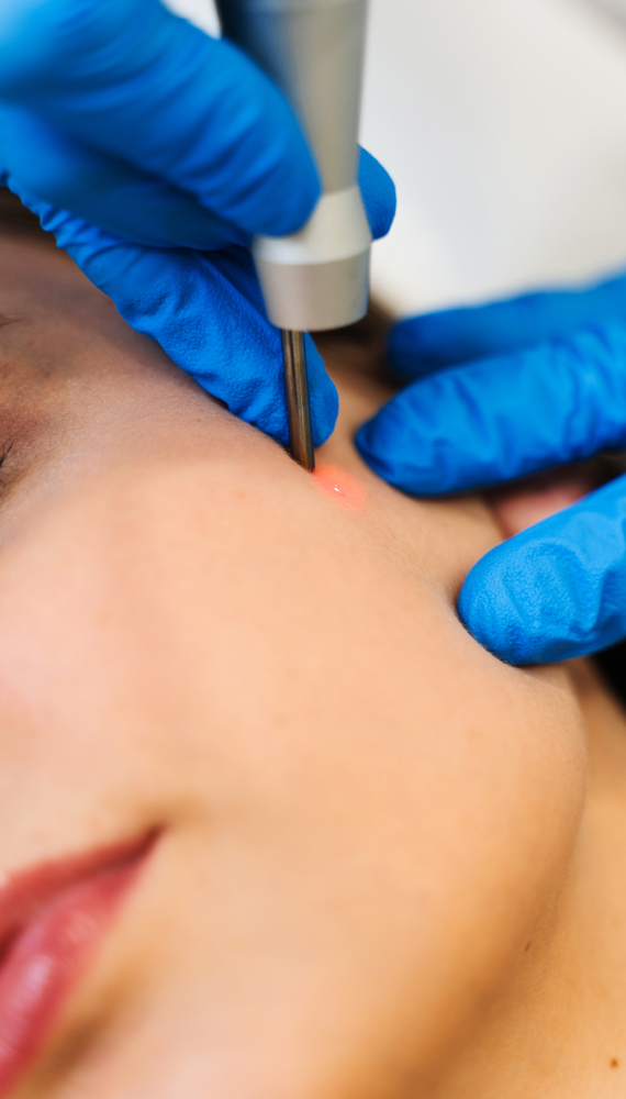 A close-up of a person's cheek being treated with a pico laser, featuring gloved hands and a laser apparatus.