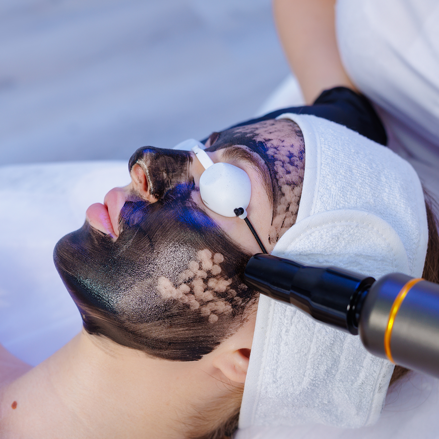 A woman undergoing a laser carbon peeling facial procedure with protective eyewear and a professional device.