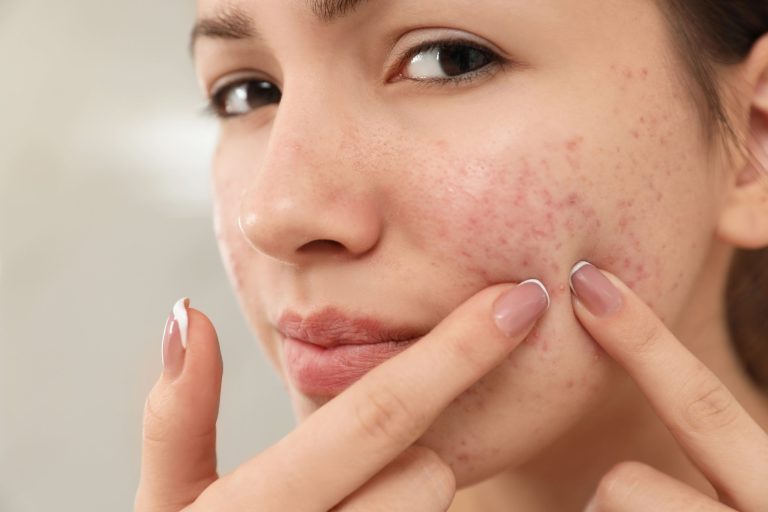 A young woman closely examining her skin, highlighting imperfections, such as acne, in a well-lit setting.