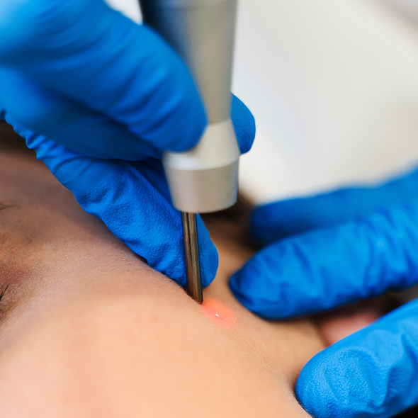 A close-up view of a laser skin treatment being performed on a woman's face by a professional wearing gloves.